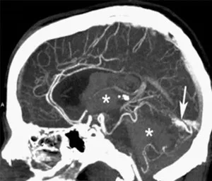 MRI image of brain with white arrow pointing right.