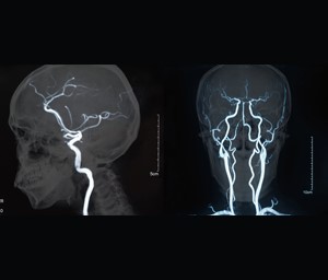 Two MRI scans revealing a wire inside two human skulls