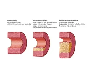 The Diagram shows Atherosclerosis stages