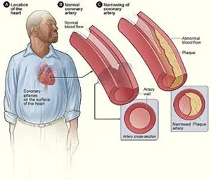 a man with the location of the heart indicated on his chest and An artery cross-section shows a comparison between a normal artery and one narrowed by plaque.