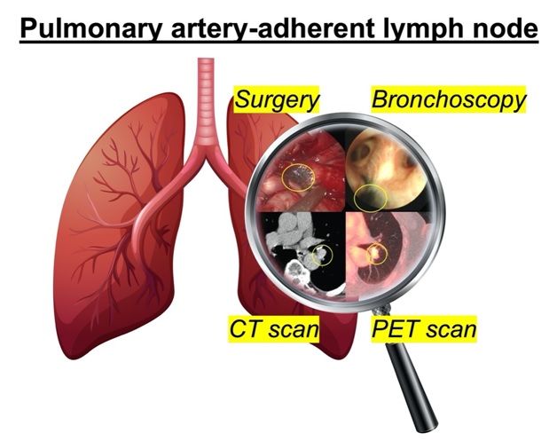 Anatomical diagram of lymph node near pulmonary artery