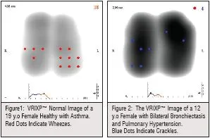 the VRIXP image of y.o female healthy with asthma red dots indicate wheezes