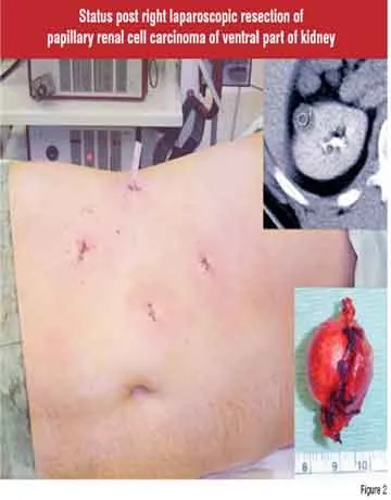 Right Radical Laparoscopic Resection